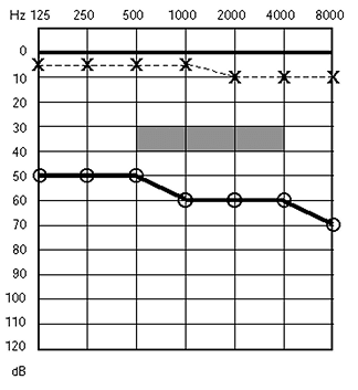 Baisse auditive de transmission